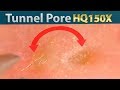 Tunnel Pore (Pull out Blackhead) | トンネル毛穴(角栓をピンセットで抜く)