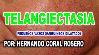 Telangiectasia síndrome de definir el