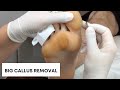 Callus Removal | Θεραπεία Κάλων | Ποδίατρος Αθήνα | Ποδολογικό Κέντρο Αθήνα