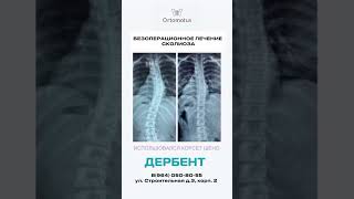 Лечение сколиоза в Дербенте ☎️ 8(964) 050-80-55