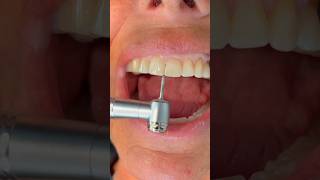 Reshaping Worn / Chipped Teeth After Braces Or Invisalign