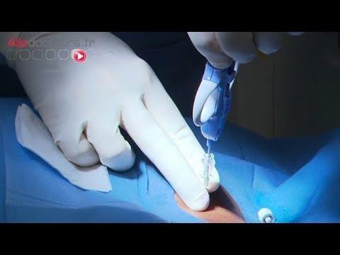 Vidéo: Biopsie Des Ganglions Lymphatiques: Objectif, Procédure Et Risques