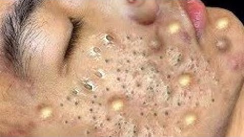 Most Viral Pimple Popping Compilation 2025 🔥