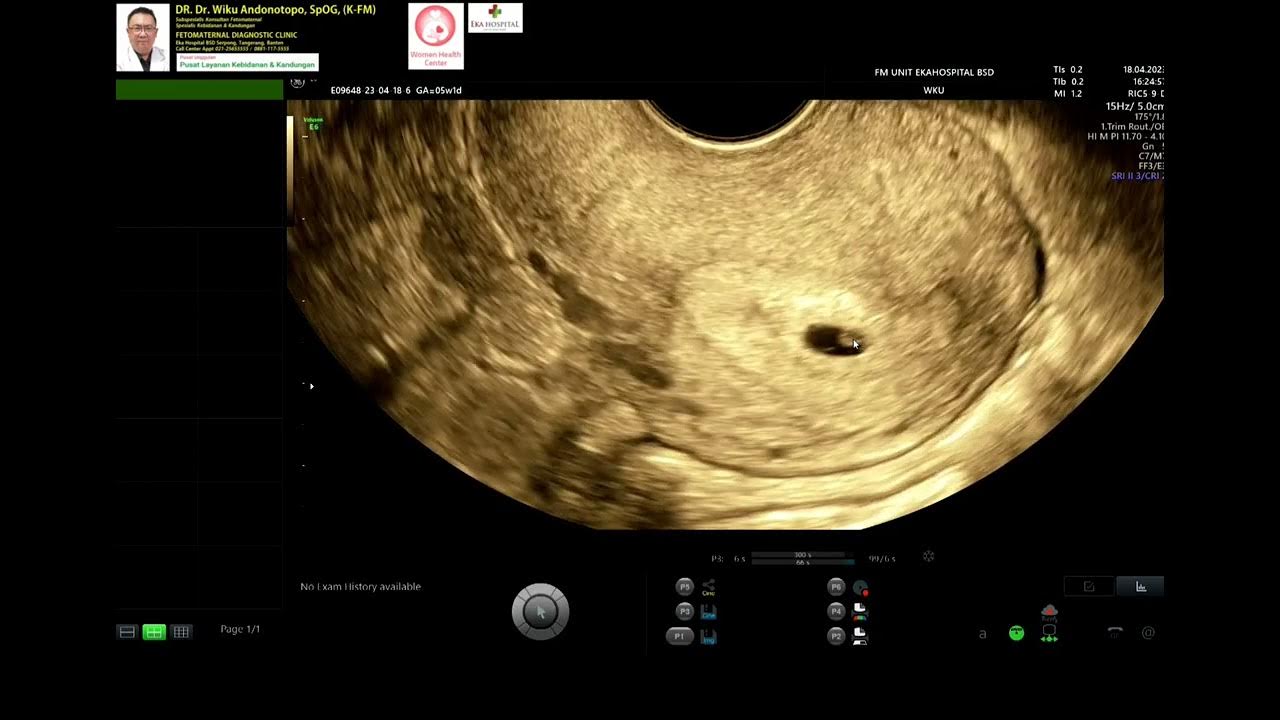 Early Pregnancy 5 Weeks Normal Intrauterine Dr Wiku Andonotopo YouTube early-pregnancy-5-weeks-normal-intrauterine-dr-wiku-andonotopo-youtube