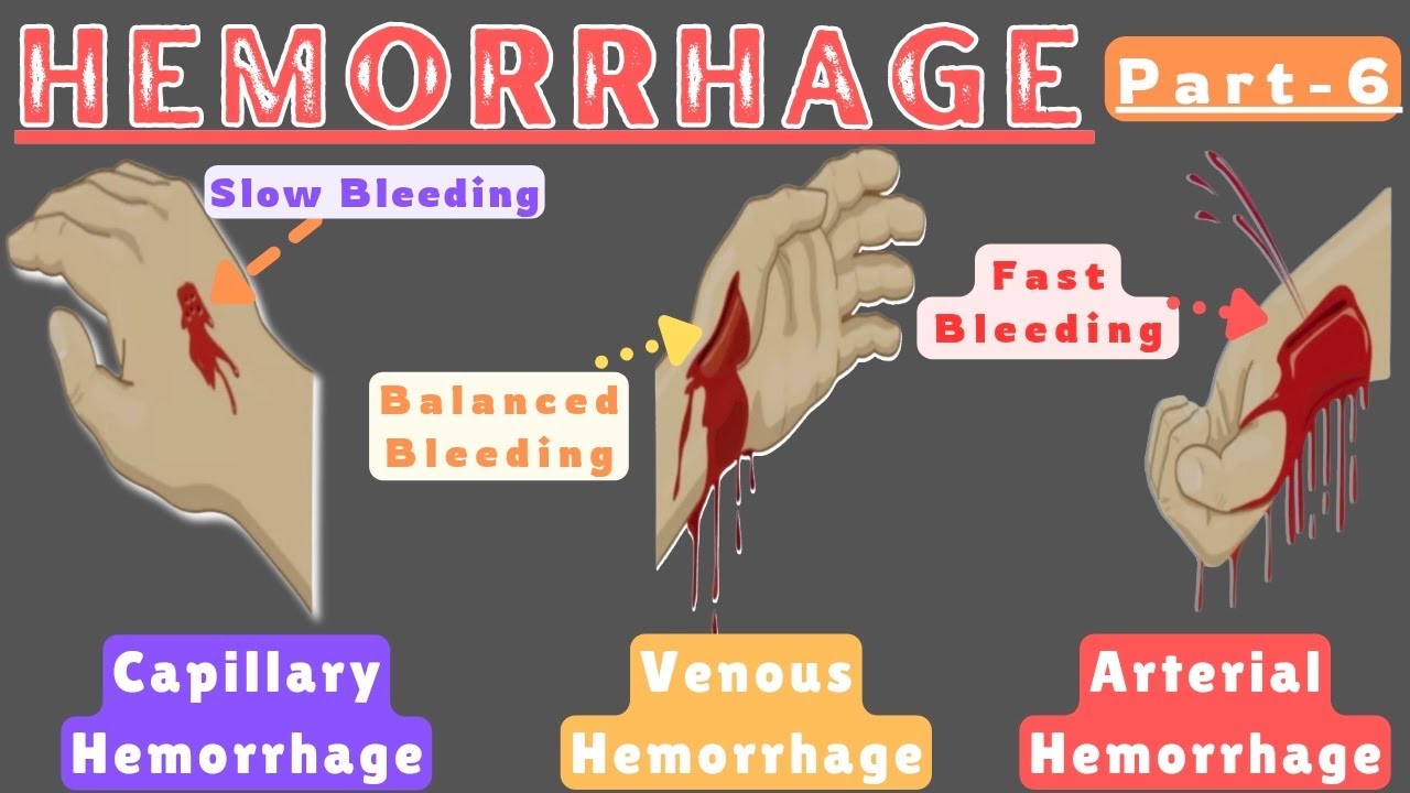 Types of Hemorrhage Based on Source: Arterial, Venous, Capillary - YouTube