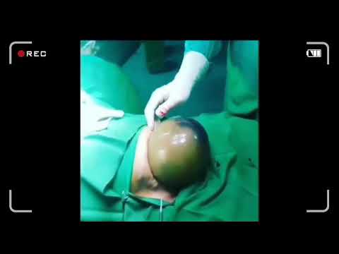 Cesarean delivery / c-section : Surgical technique - HD Video