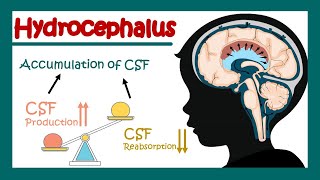 Hydrocephalus | What can cause hydrocephalus? | Communicating vs non communicating hydrocephalus