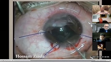 Mission Impossible in cataract surgery !!! Ziada eye academy#Hossam Ziada#