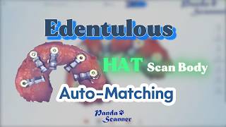 Edentulous HAT Scan Body Auto-Matching Guide