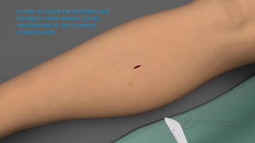 Tibial Transverse Transport External Fixation System