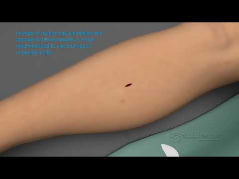Tibial Transverse Transport