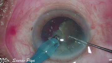PHACOEMULSIFICATION - Dr. Saurav Piya