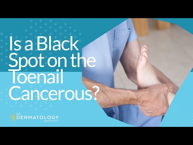 Is the Dark Spot Under My Toenail Dangerous? - YouTube