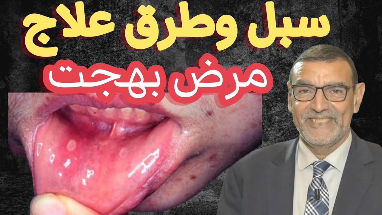 سبل وطرق علاج مرض بهجت الدكتور محمد الفايد