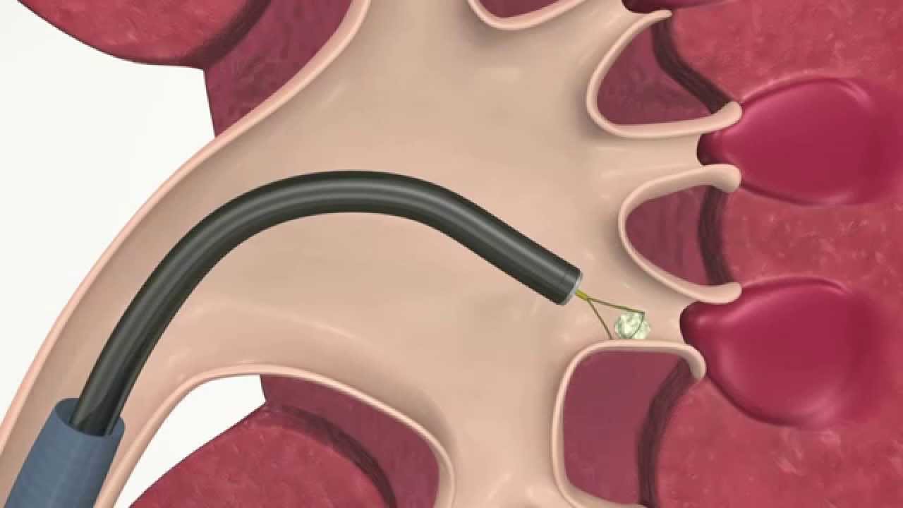 Extractor de Cálculos NGage de Cook Medical YouTube