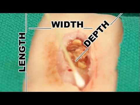 wound-measurement--understand-wound-care