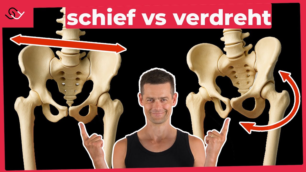 Beckenschiefstand oder verdreht? Mach den Test! (Lösung inkl.)