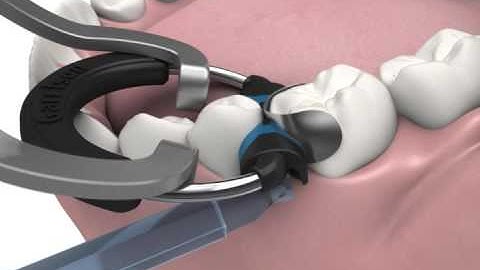 Garrison Class II Composite Restoration Demo