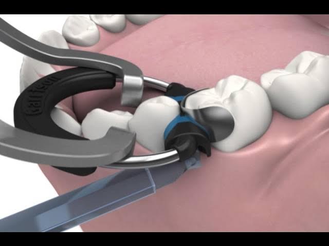 Garrison Dental Solutions - Composi-Tight 3D XR Sectional Matrix System 