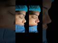 Rinoplastia Dr Jaimes 02/04/26