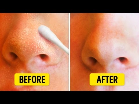 How to get rid of blackheads? clear and beautiful skin is one the main elements your beauty. but guess what? you don’t have waste money on cosm...