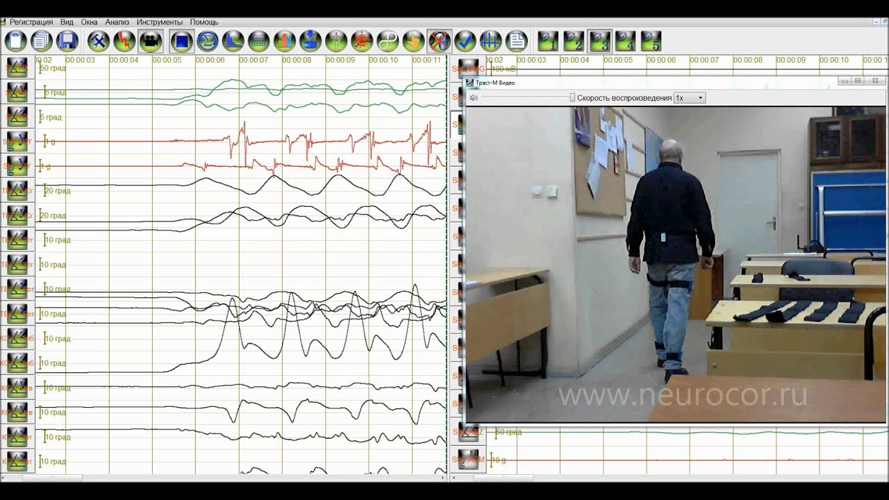 Деформирующий остеоартроз левого коленного сустава - YouTube