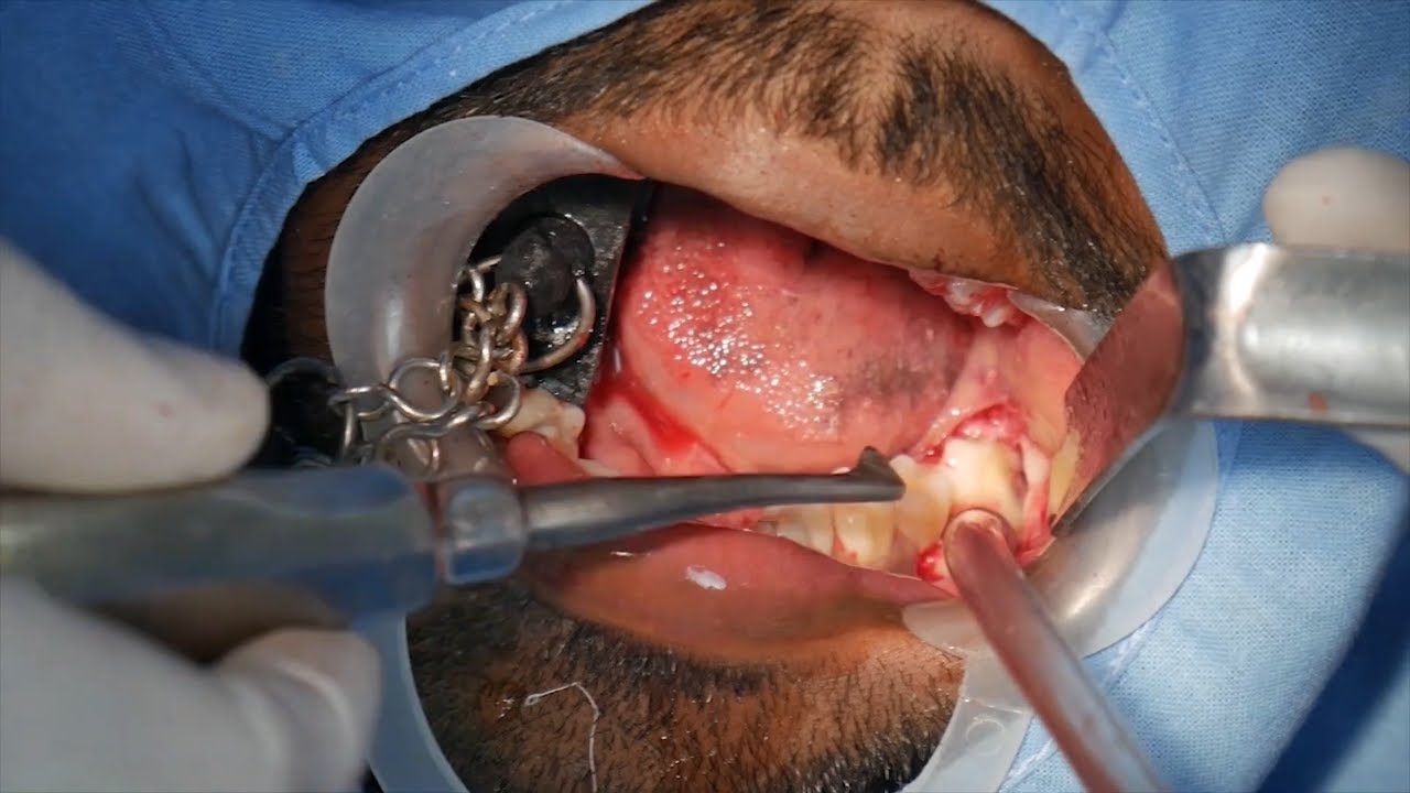 Wisdom tooth removal in 5 MIN or less -  Dr. Sunil Richardson