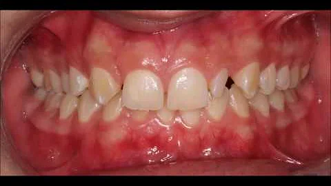 O que é agenesia dos dentes?