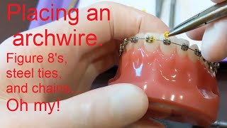 Placing an Archwire