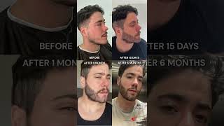 6 Month Beard Transplant Transformation in Turkey 🔥