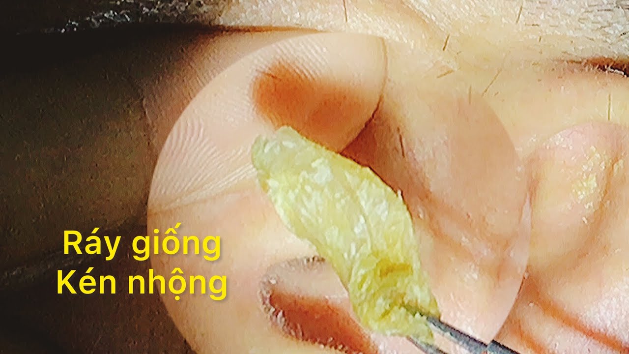 Lấy ráy tai. Phần 13, chú nghe rõ rồi .#earwaxextraction #Y MEN HAIR LS ...