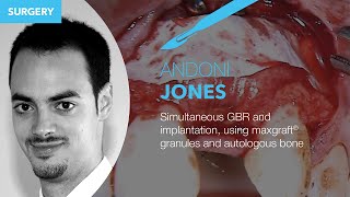 Andoni Jones: Surgery Simultaneous GBR and implantation using maxgraft® granules and autologous bone
