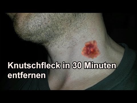 Machen knutschflecken burliraven: Freundin