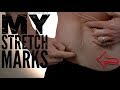 My Stretch Mark Story: How to Reduce the Appearance of Stretch marks- Thomas DeLauer