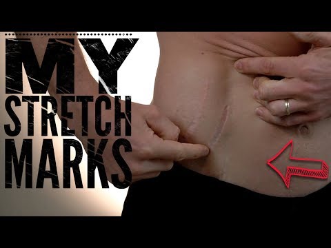 My Stretch Mark Story: How to Reduce the Appearance of Stretch marks- Thomas DeLauer