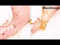 【角栓除去】イモムシ?大量のニキビを芯出しするのって気持ちいい/Blackhead Removal Show