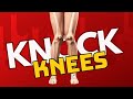 Knock Knees? Causes and Results. What causes your knees to "go in"?