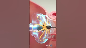 What is Pulsed Field Ablation (PFA)?