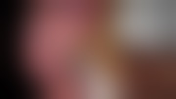 uniportal VATS RUL + LND (unsuspected N2)