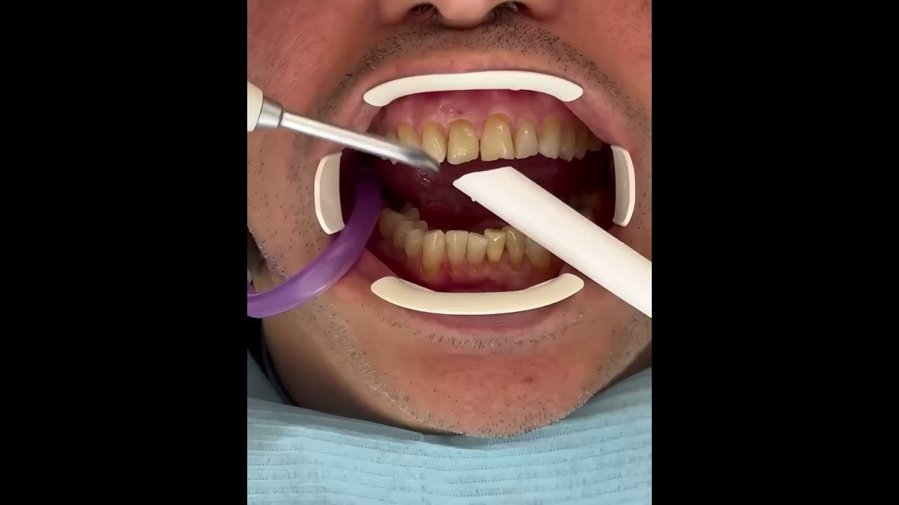 IVENEER spoon technique 