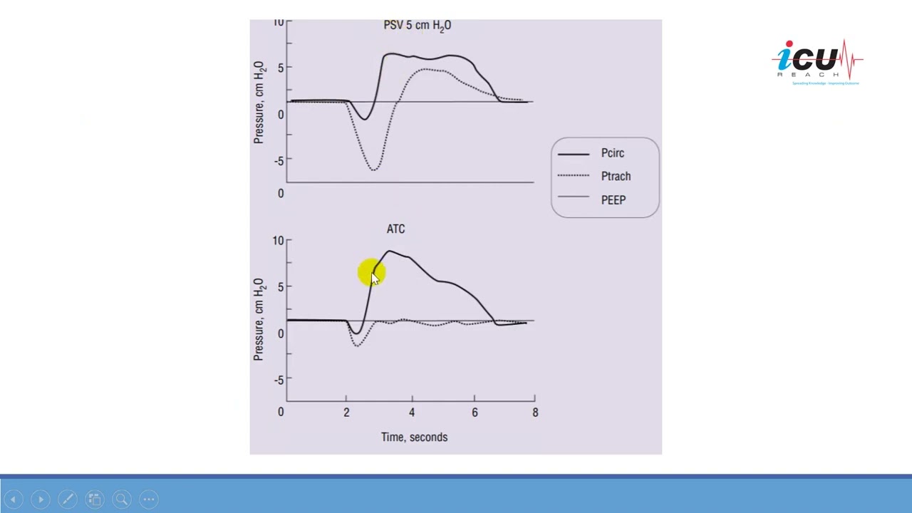 Automatic Tube Compensation on Mechanical Ventilation
