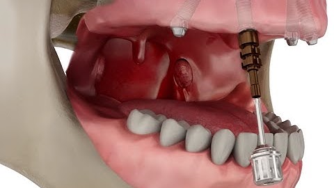 Straumann Pro Arch Step by Step Overview