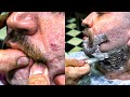 ASMR BEARD CUT • Acne removal and Turkish massage • Barber Numan
