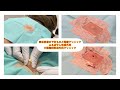 背部の小さな粉瘤　ブログでも粉瘤について詳しく解説してます。東京皮膚のデキモノと粉瘤クリニック　ふるばやし形成外科　東京新宿院　大阪梅田形成外科クリニック
