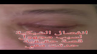 انفصال الشبكية قصة حقيقية مرعبة حدثت معي retinal detachment