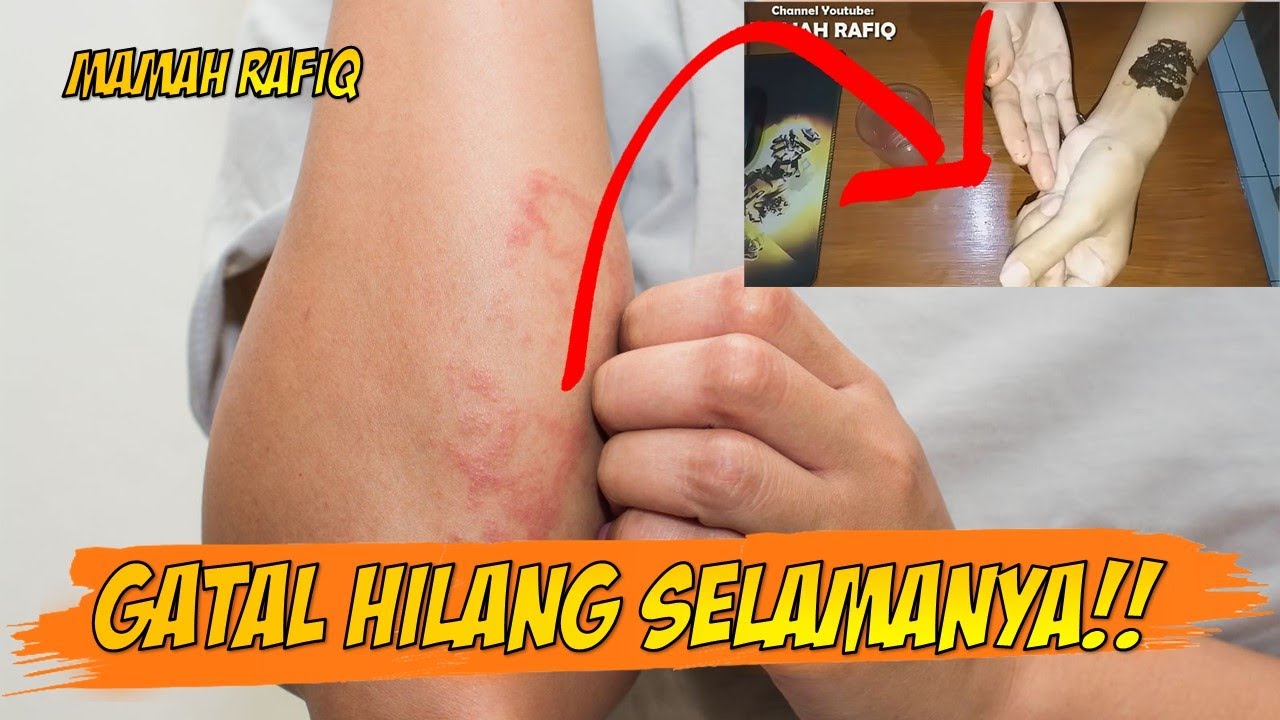 HANYA 5 MENIT! Obat GATAL & Penyakit Kulit Alami Paling Ampuh di Dunia