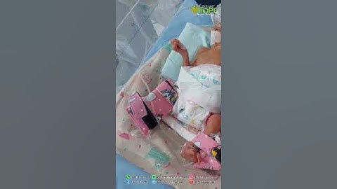 Galang Dana Baby Olivia Albertazalea  lahir Prematur pada usia kandungan 7 bulan
