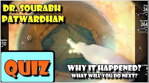 79 Quiz: Posterior capsule capture- Why it happened, How will you proceed Dr sourabh patwardhan