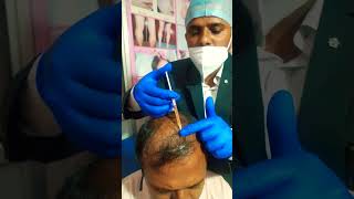 Hair Loss Treatment by PRP, Derma pen,