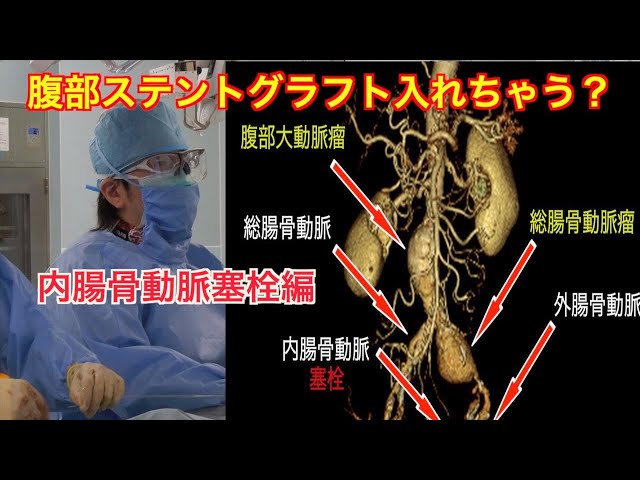腹部大動脈瘤 内腸骨動脈塞栓術編 血管内治療 ステントグラフト EVAR